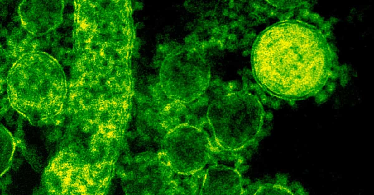 Epstein-Barr Virus Found to Actively Remodel Genome in Nasopharyngeal Carcinoma Progression Epstein-Barr Virus Found to Actively Remodel Genome in Nasopharyngeal Carcinoma Progression-1